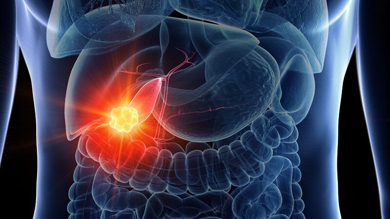 Key Factors Predict Gallbladder Cancer on Routine Cholecystectomy