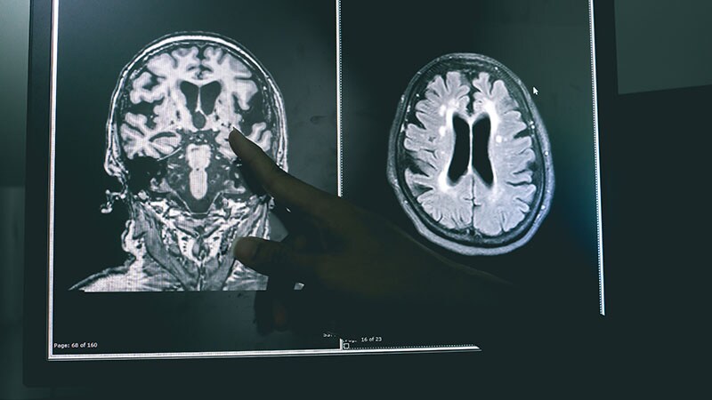 Tirofiban Superior to Aspirin in Stroke Without Large Occlusion