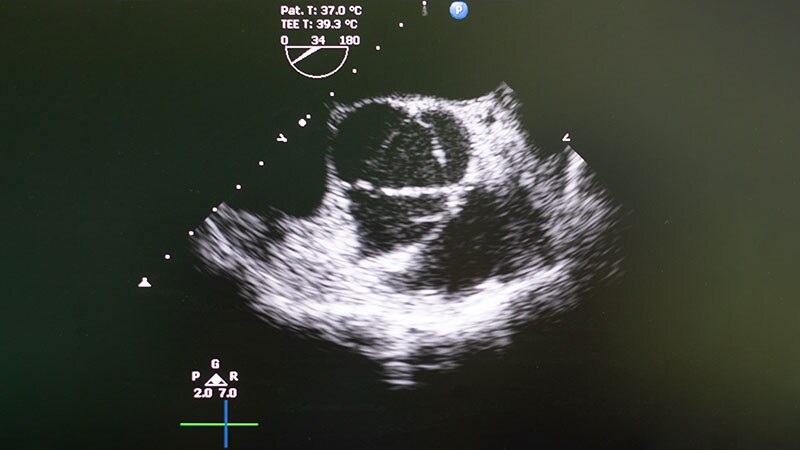 Encouraging 3-Year Data for TAVR in Low-Risk Patients: EVOLUT