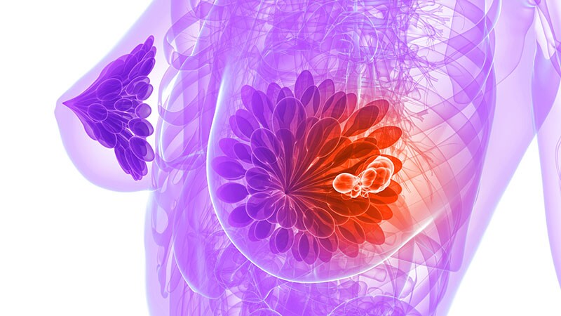 Fasting During Breast Cancer Chemo Improves Quality of Life