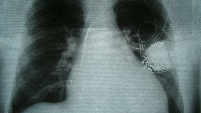 Negative Adaptive CRT Trial Yields Useful Clinical Messages