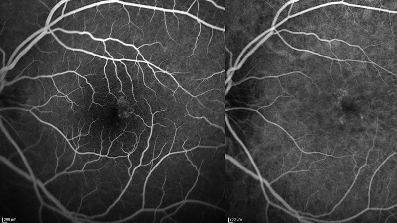 Trio Who Invented Eye Test Wins Lasker Prize