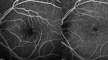 Trio Who Invented Eye Test Wins Lasker Prize