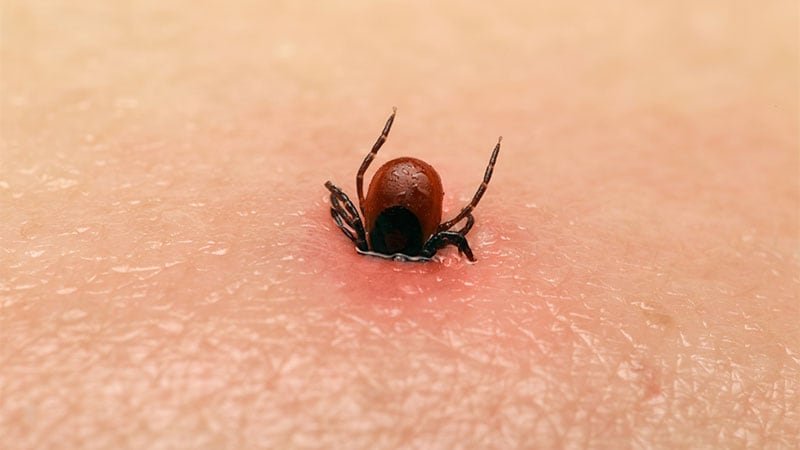 Vaccines, Better Tests Are Coming for Lyme Disease