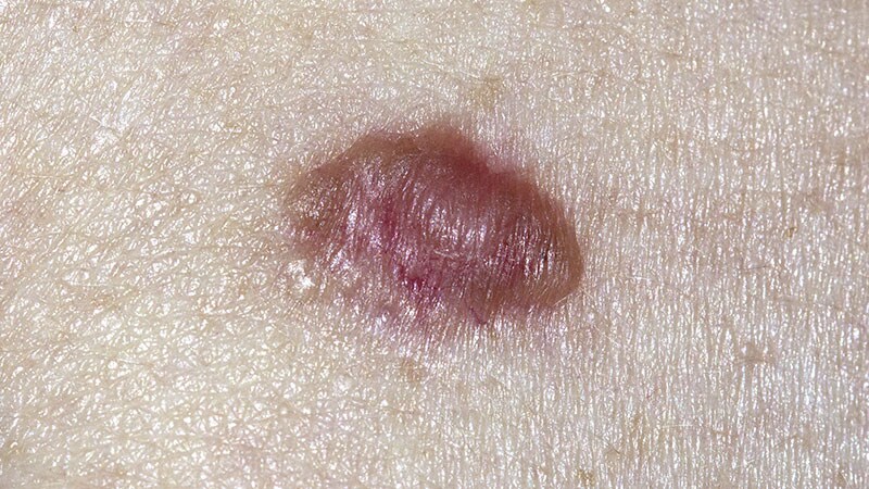 Treating BCC: Early Data on Controlled Hyperthermia