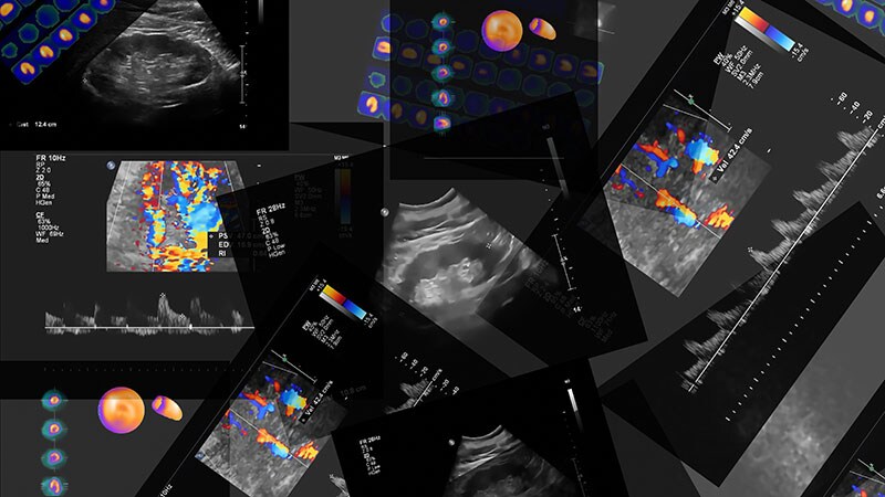 Stroke Scale Cutoff Might Not Be Ideal Guide