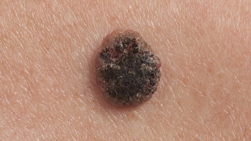 Genetic Profiling Identifies High-Risk Cutaneous SCC Tumors