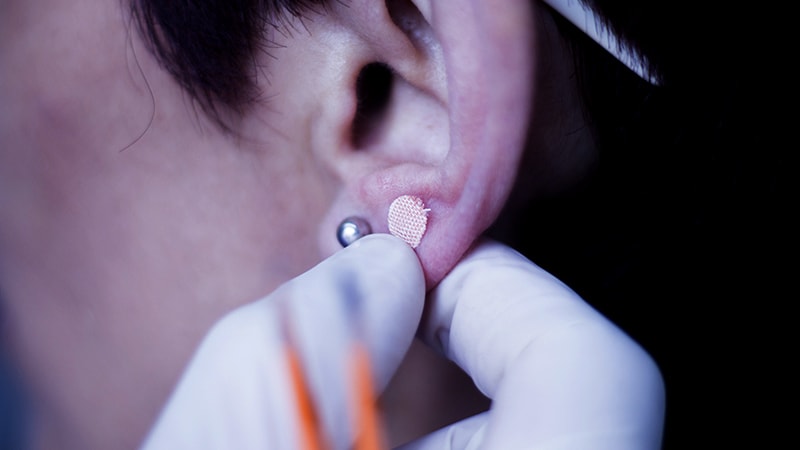 Ear Acupuncture With Diet Aids Weight Loss 