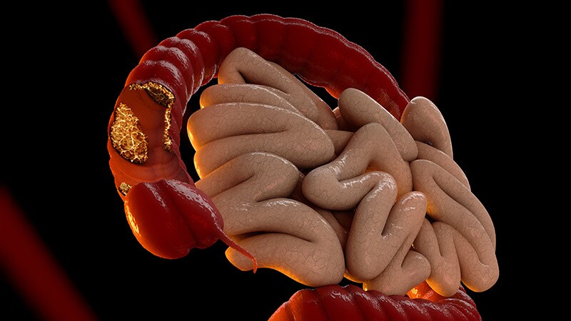 Colon Cancer Risk Quadruples Within Year of Appendicitis