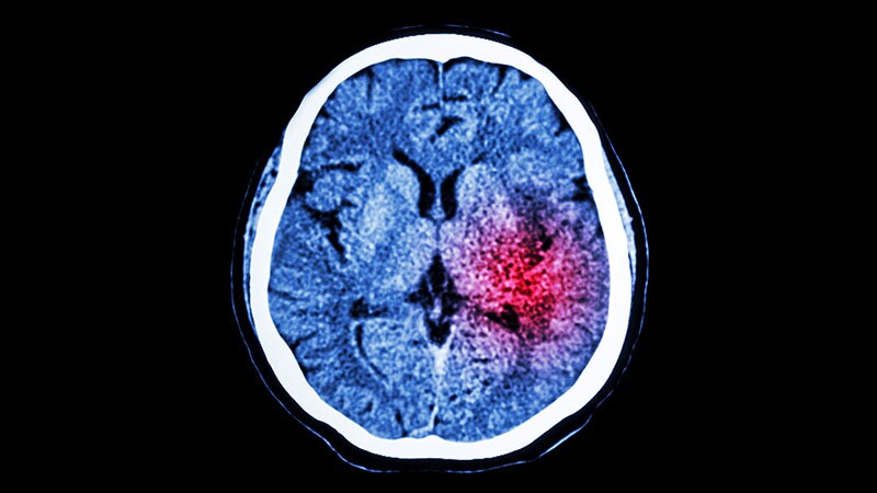 Cardiopathy No Basis for Choosing Anticoagulation in ESUS