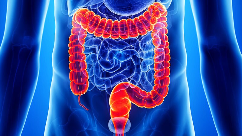 Aspirin Use Tied to Lower Risk for Early Colorectal Cancer