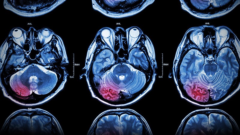 Immediate Statin After Acute Stroke Reduces Disability