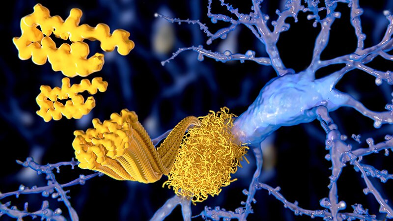 Solanezumab for Preclinical Alzheimer's: Phase 3 Data