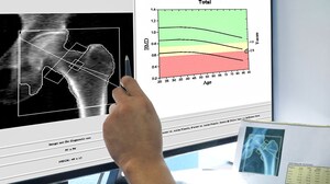 Preventing 'Worm-eaten Bones' From Hyperthyroidism