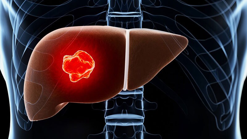Liver Cancer Causes Differ Markedly by Race/Ethnicity