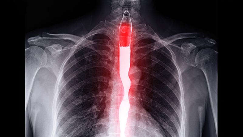 Frequency and Duration of GERD Associated With Poor Sleep