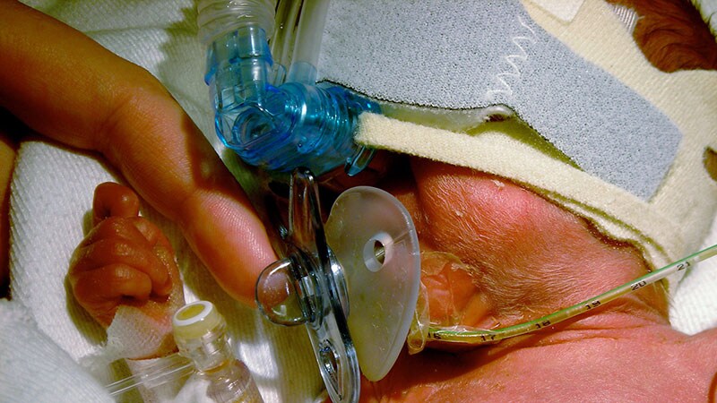 Surfactant Shows Some Benefit in Infants' First 2 Years