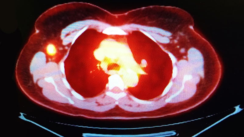 Rapid Rx Quiz: Metastatic Breast Cancer