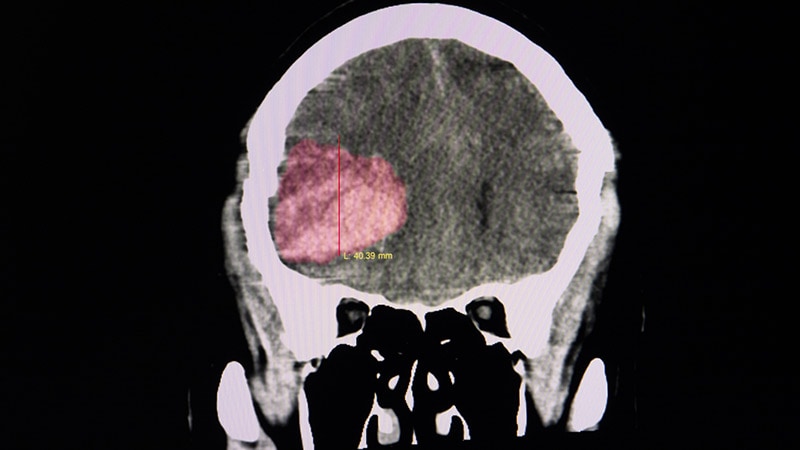 Andexanet Aids Hemostasis in ICH Tied to FXa Inhibitors