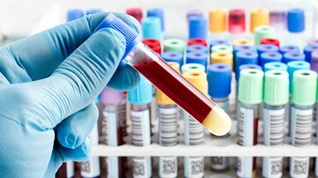A Blood Test to Diagnose Bipolar Disorder? 