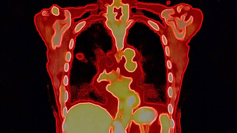 Selpercatinib Extends PFS in First-line RET-Positive NSCLC