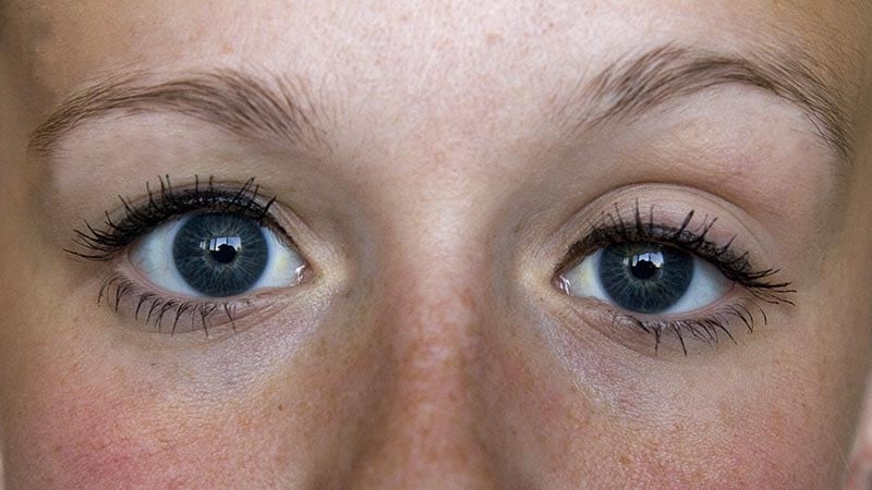 US Study Finds Unexpectedly High Prevalence of MG