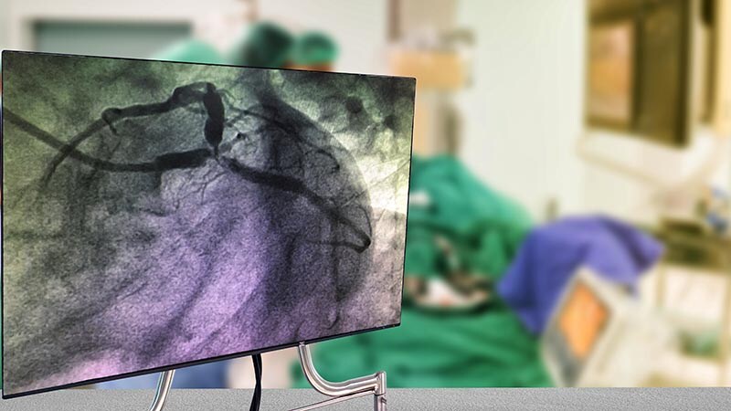 Angioplasty Finally Proven Beneficial in Stable Angina