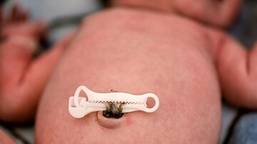 More Preterm Babies Survived After Delayed Cord Clamping
