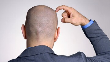 At 52 Weeks, Hair Growth Still Climbing on Deuruxolitinib