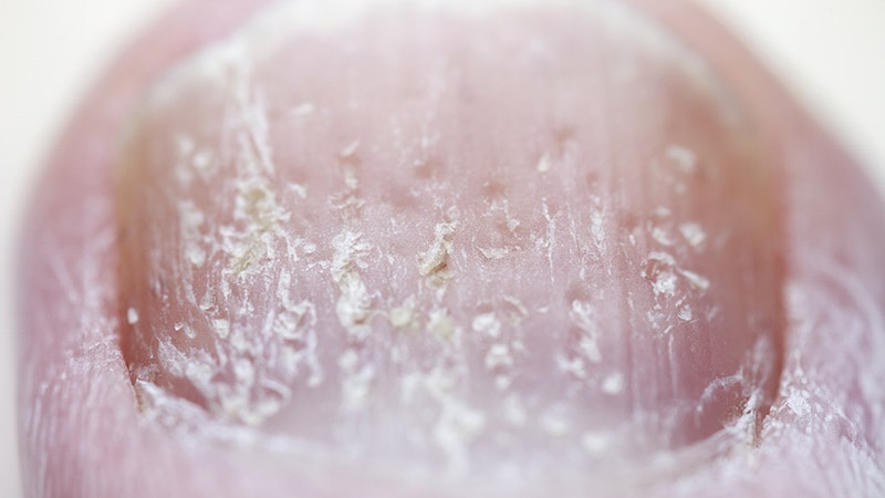 Nail Psoriasis in Black Patients Often Overlooked