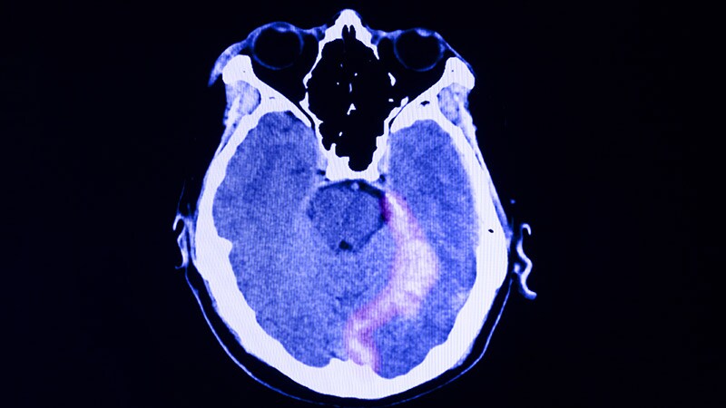 Experimental Tx Restores Cognitive Function in Chronic TBI