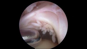 Emotional 'Grit' Related to Function After Rotator Cuff Surgery