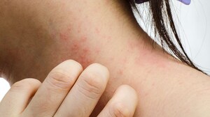 Dupilumab Effective for Up to 1 Year in Teens With AD: Study