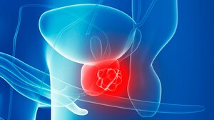 Prostate Cancer Subgroup May Benefit From Intensified Therapy