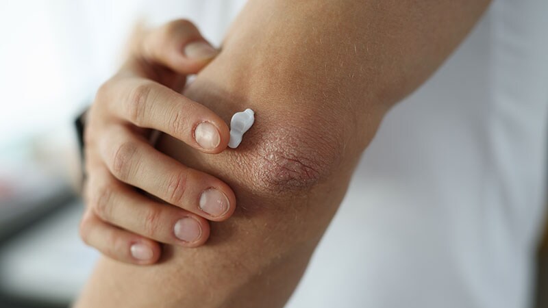 Novel Topical Found Effective for Psoriasis in 52-Week Study