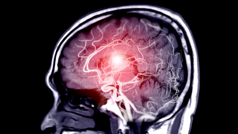 Stroke Prevalence Stable in US Over Past 20 Years 