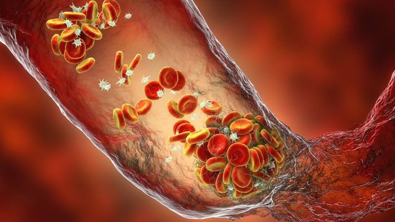 Oral Factor XIa Inhibitor Cuts Post-Op VTE Risk: AXIOMATIC-TKR