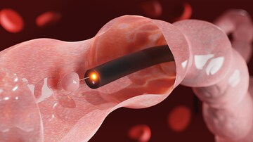Anesthesia Care Team May Be Quicker for GI Endoscopy