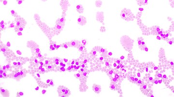 Zanubrutinib Shows Worth Against Standard CLL Drugs