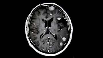 Reducing Cognitive Impairment From SCLC Brain Metastases