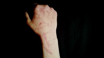 Three Symptoms Suggest Higher Risk for Self-injury in Cancer