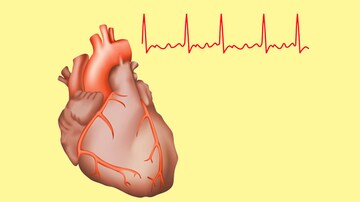 Recurrent Stroke Risk High in AF, Even With Anticoagulants