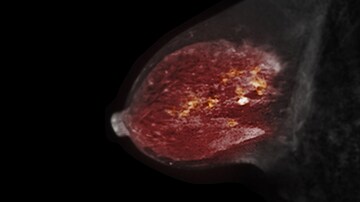 How to Weed Out False Positives on Breast MRIs