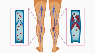 Cancer Patients Unaware of Their Increased Thrombosis Risk