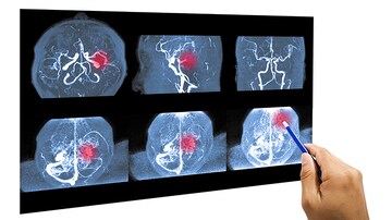 Updated AHA/ASA Guideline Changes Care for Spontaneous ICH