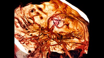 Genomic Risk Score Predicts Intracerebral Hemorrhage Risk