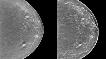New Image-Based Risk Model Helps Predict Future Breast Cancers