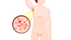 Study Looks at Most Common Features of HS in Pediatric Patients