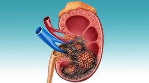 New Diagnostic Imaging Agent Identifies Clear Cell Renal Cancer
