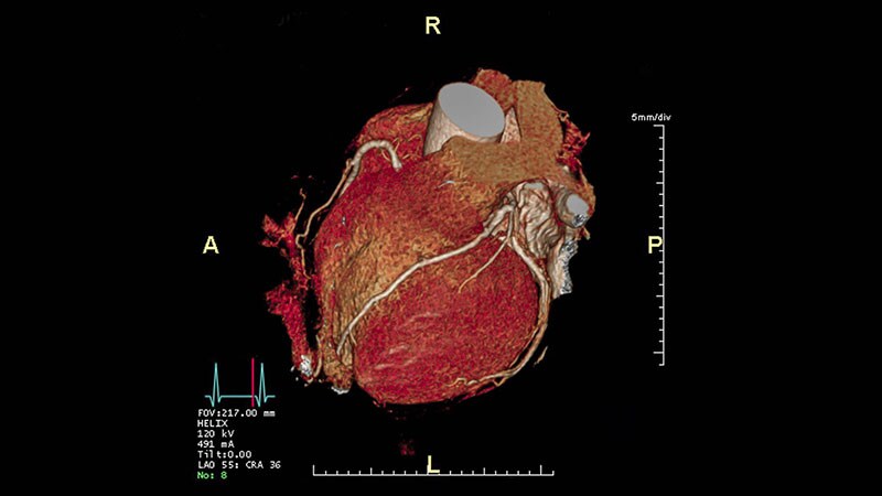 Angiography After CABG Safer When Planned With CTCA